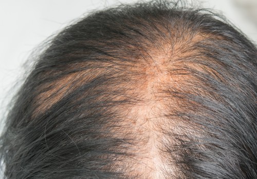 The Best Hair Loss Treatments in Ada County, Idaho